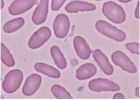 橢圓形紅細胞：增多見於遺傳橢（遺傳性橢圓形紅細胞增多症）。