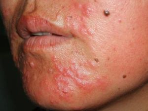 肺風粉刺 肺風粉刺