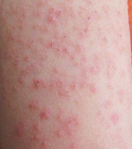 過敏性蕁麻疹 過敏性蕁麻疹