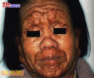 臨床診斷圖片，正面