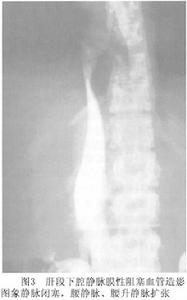 巴德-恰里綜合徵