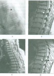 頸椎黃韌帶骨化症