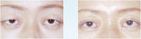 上瞼下垂矯正術手術對比
