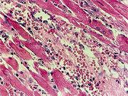 變質性炎 變質性炎