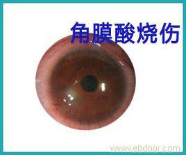 角膜酸燒傷 角膜酸燒傷
