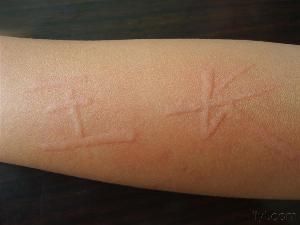 人工性尋麻疹 人工性尋麻疹
