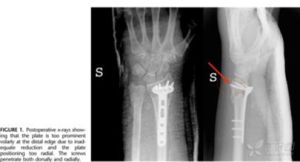 巴頓骨折 巴頓骨折
