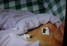 連續輸液時的輸液港