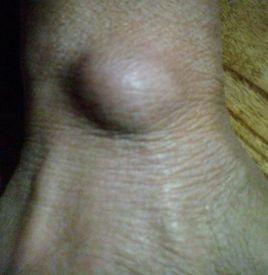 疲勞性骨膜炎 疲勞性骨膜炎