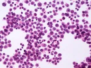 鐵粒幼細胞性貧血