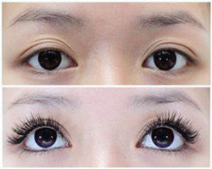 睫毛移植術 睫毛移植術