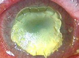 眼前異常閃光,增加的黑點 眼前異常閃光,增加的黑點