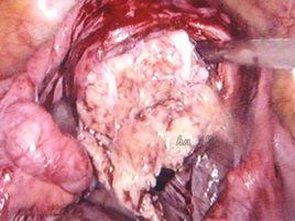 宮頸贅生物 宮頸贅生物