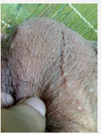 陰囊濕疹 陰囊濕疹