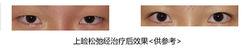 上瞼鬆弛治療效果