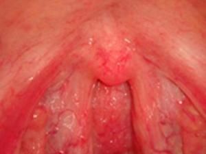 咽後壁淋巴濾泡增生