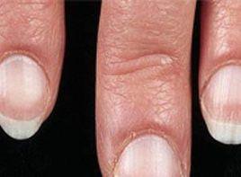 指甲類似雲母 指甲類似雲母