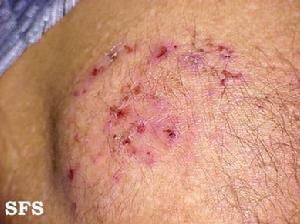 幼年型皰疹樣皮炎