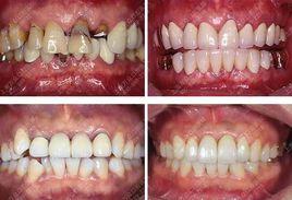 先天性出齦牙齒 先天性出齦牙齒