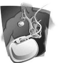 心臟起博器 心臟起博器