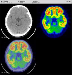 結節性硬化症 結節性硬化症