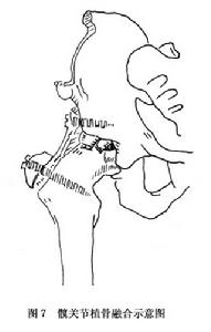 （圖）髖關節結核病