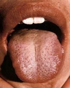 肝膽濕熱 肝膽濕熱