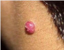 肉芽腫瘤 肉芽腫瘤