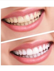 牙齒漂白 牙齒漂白