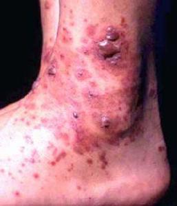 過敏性紫癜療法 過敏性紫癜療法