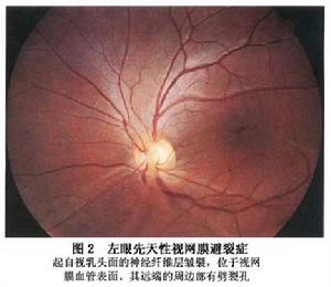 先天性視網膜劈裂症