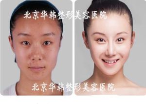 矽膠隆鼻手術 矽膠隆鼻手術