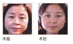 雅光射頻除皺前後對比圖