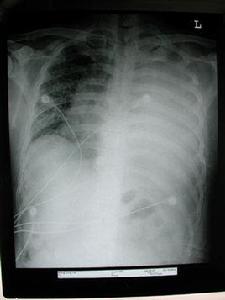 惡性胸水 惡性胸水