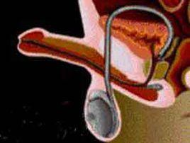 射精功能障礙疾病 射精功能障礙疾病