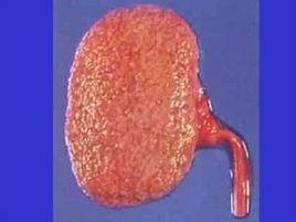 免疫性腎病 免疫性腎病