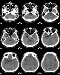 患了病毒性腦炎的檢查