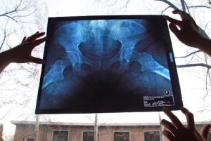 非典後遺症 非典後遺症