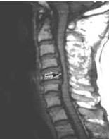 腰椎椎管狹窄症