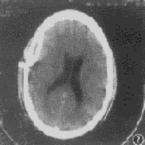 硬腦膜下膿腫 硬腦膜下膿腫