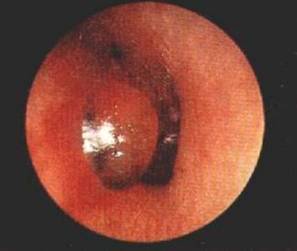 急性化膿性中耳炎