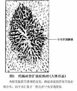 結腸血管擴張症