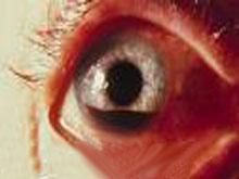 運動性眼外傷 運動性眼外傷