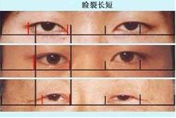 內眥贅皮修整術