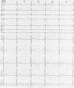 竇性心律過緩 竇性心律過緩