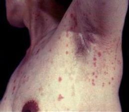 紅色斑丘疹 紅色斑丘疹