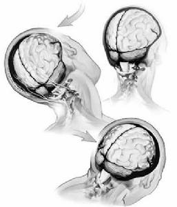 腦損傷后綜合征