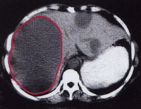 （圖）肝臟惡性血管瘤