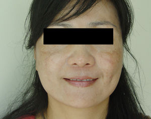 孕期黃褐斑 孕期黃褐斑