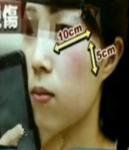 電輻燙傷 電輻燙傷